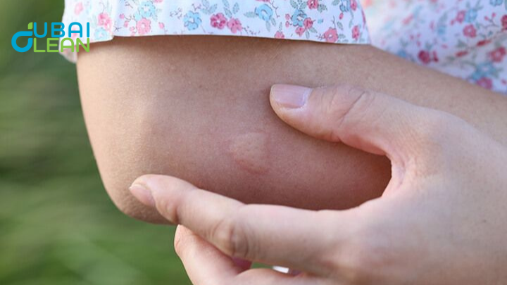 Bed Bug Bites
